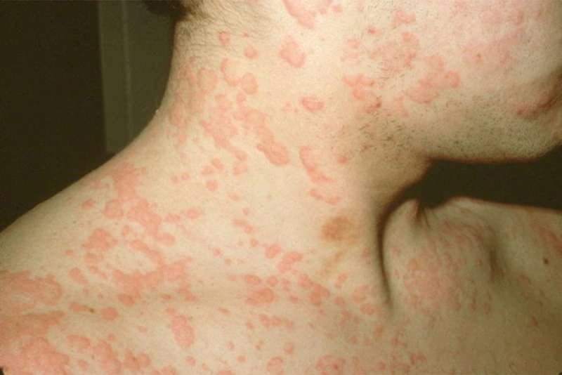 Hướng dẫn chăm sóc người bệnh dị ứng thuốc2