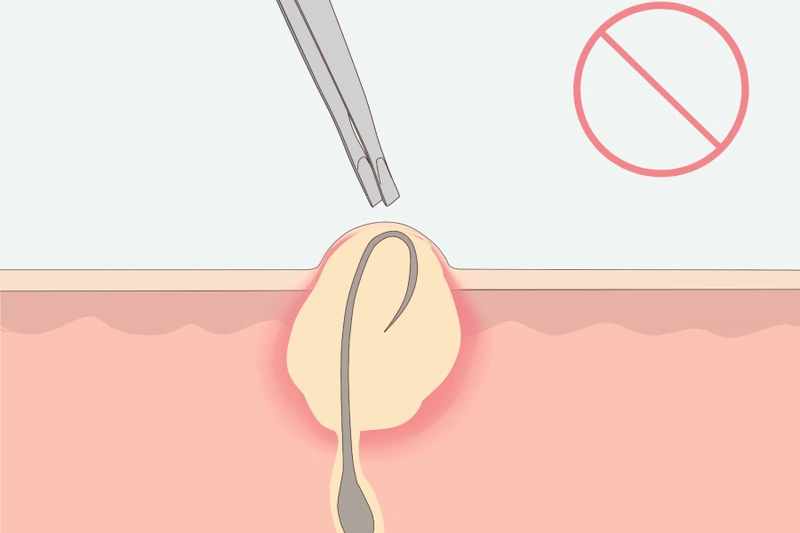 [Hướng dẫn] Điều trị và ngăn ngừa lông vùng kín mọc ngược 5