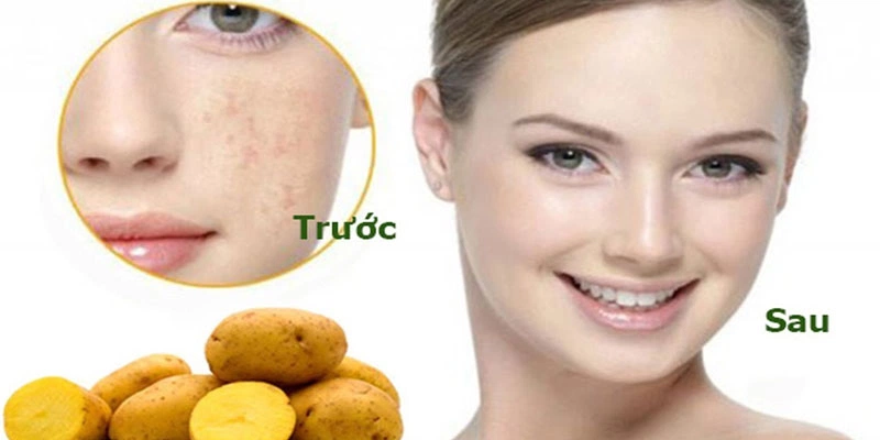 Hướng dẫn làm mặt nạ đánh bay tàn nhang tại nhà hiệu quả 2