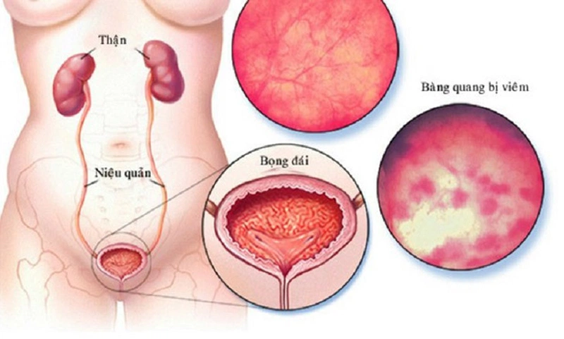 Tác động lên huyệt khúc cốt hỗ trợ điều trị viêm bàng quang hiệu quả