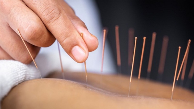 Châm cứu là phương pháp tác động lên huyệt kỳ môn phổ biến và có hiệu quả