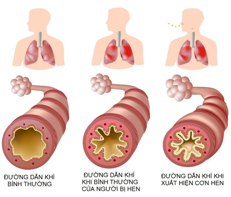 Kiên trì điều trị hoặc tác động lên huyệt Phong Long có thể chữa trị các cơn ho, khó thở của bệnh hen phế quản