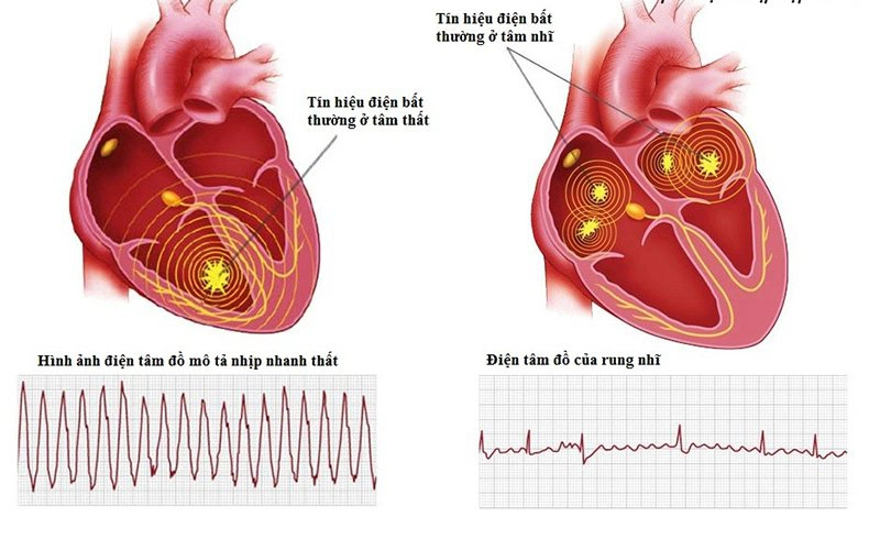 Tác động huyệt tâm du có thể hỗ trợ điều trị tình trạng rối loạn nhịp tim