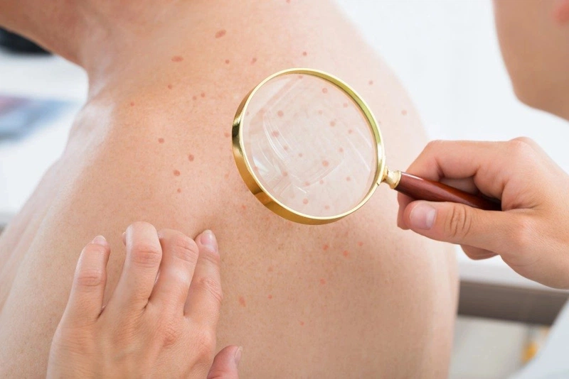 Nốt ruồi son là gì? Làm thế nào để xóa nút ruồi son? 1