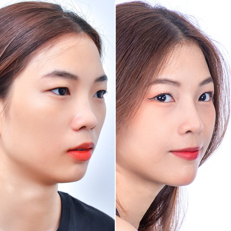 Thu gọn cánh mũi có đau không? 2