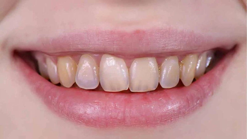 Kem đánh răng than hoạt tính có thể làm mòn chân răng