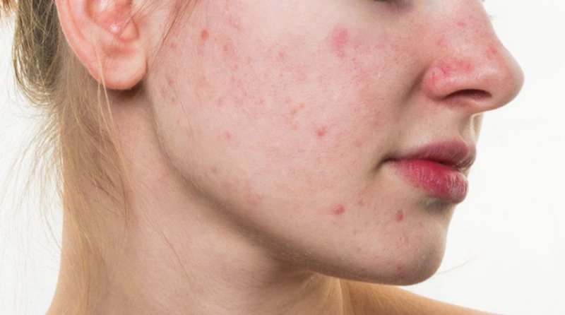 Hợp chất Azelaic acid có trong kem trị mụn Derma Forte giúp điều trị mụn trứng cá và làm mờ những vết thâm do mụn