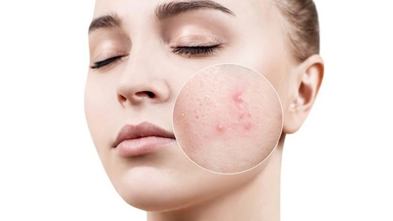 Hoạt chất Adapalene trong tuýp Differin giúp làm xẹp mụn và ngăn ngừa hình thành mụn trứng cá mới