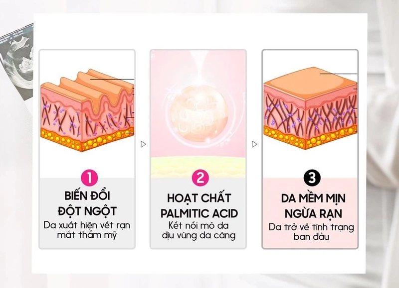 kem trị rạn da sau sinh rep 2