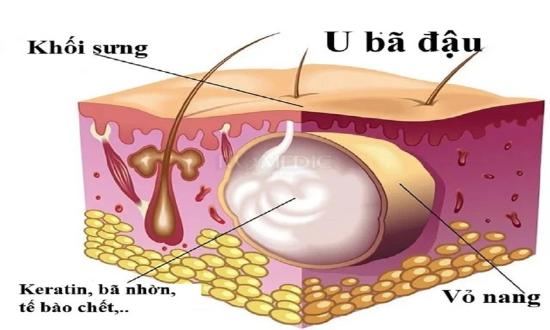 Kén bã đậu ở trẻ là bệnh gì? Kén bã đậu có nguy hiểm không? 1