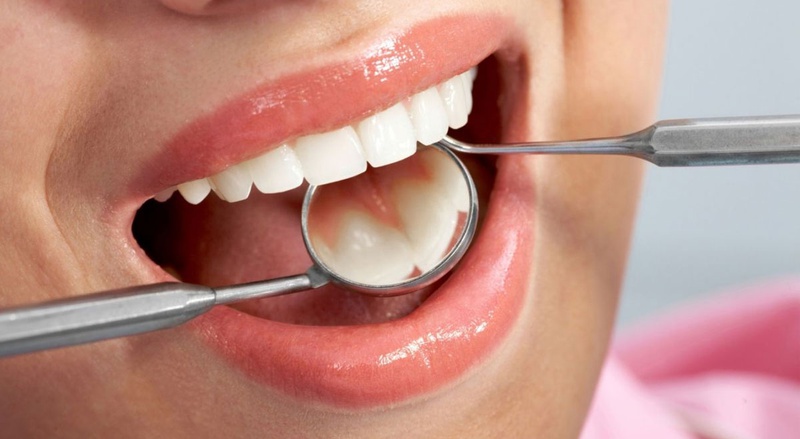Keo dán răng sứ là gì? Những loại răng sứ đang được ưa chuộng3