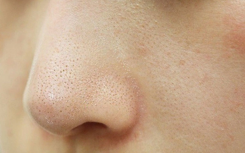 Cách trị mụn cám bằng kem đánh răng