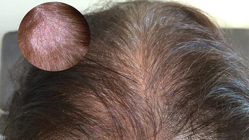 Có nên trị nấm da đầu bằng dung dịch vệ sinh?