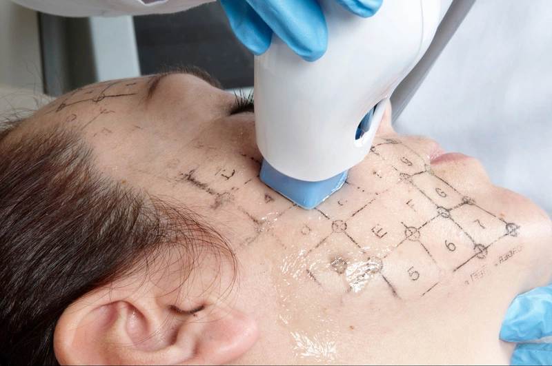 Khám phá phương pháp trẻ hóa da bằng thermage 3