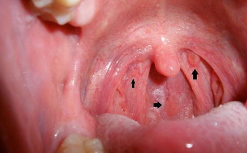 Khàn tiếng có đờm: Nguyên nhân và cách xử lý 3