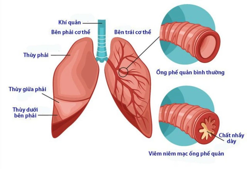 Khàn tiếng có đờm: Nguyên nhân và cách xử lý 5