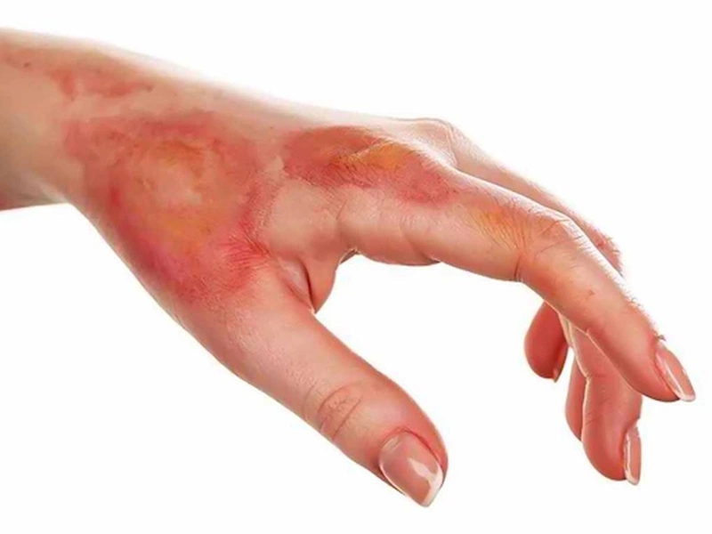 Khi bị bỏng vôi bột nên sơ cứu bằng cách nào? 2