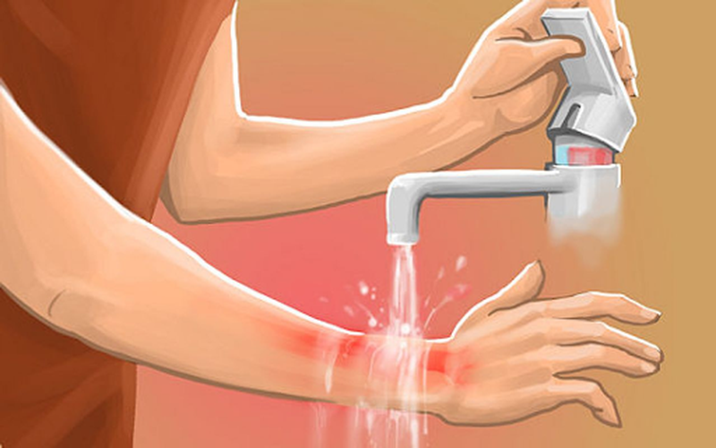 Khi bị bỏng vôi bột nên sơ cứu bằng cách nào? 3