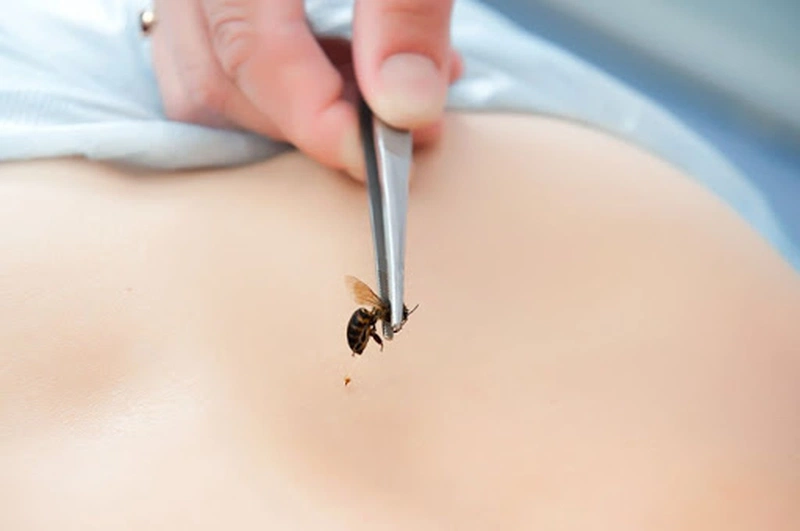 Khi bị ong đốt không nên ăn gì để giảm sưng nhanh? 1