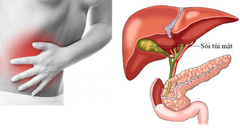 khi bị sỏi túi mật nên uống thuôc gì 1