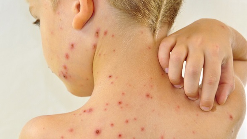 Khi nào bệnh thủy đậu hết lây 1