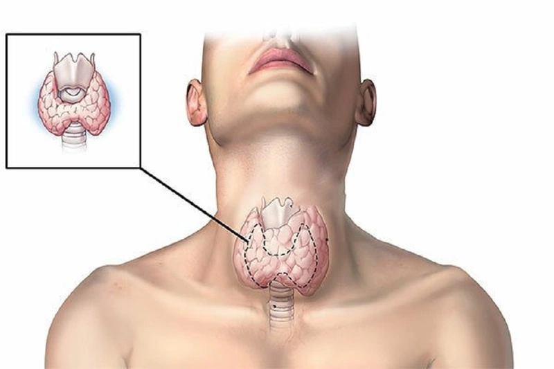 Khi nào cần điều trị bướu cổ phình giáp? 1