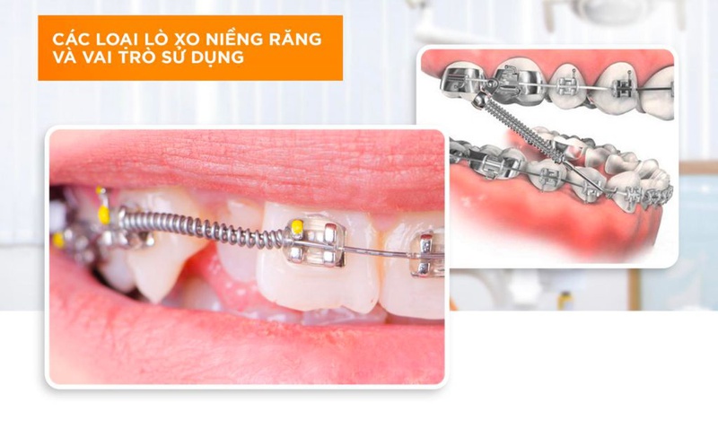 Khi nào cần dùng lò xo niềng răng? Thời gian sử dụng bao lâu? 2