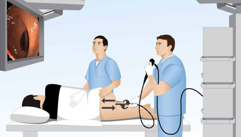 Quy trình nội soi đại tràng gồm có 3 giai đoạn: trước, trong và sau khi nội soi.