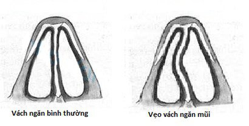Khi nào cần phẫu thuật vách ngăn mũi2