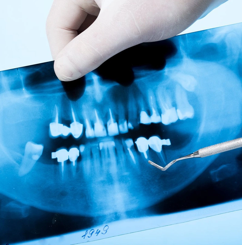Nhờ phương pháp chụp x quang răng, bác sĩ có thể kiểm tra, phát hiện các bệnh lý răng miệng