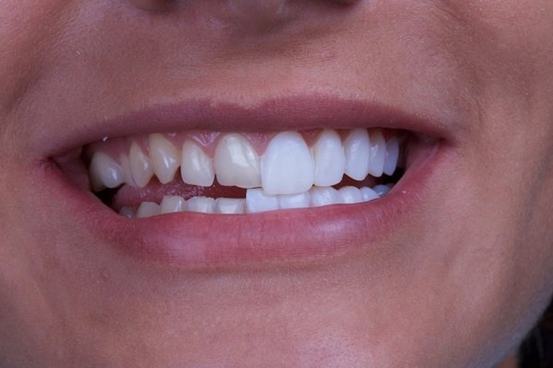 Nên dán sứ veneer hay bọc răng sứ? Cái nào tốt hơn? 2