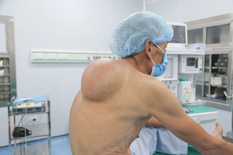 Khi nào nên phẫu thuật u mỡ ở lưng? 3