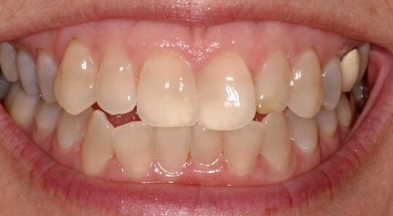Cần chăm sóc răng miệng sau khi tẩy trắng răng