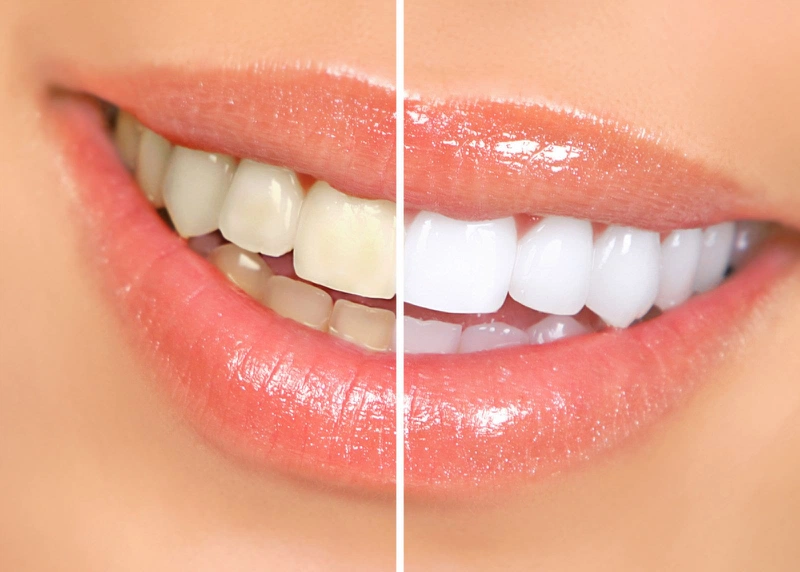 Tẩy trắng răng giúp làm màu răng trắng