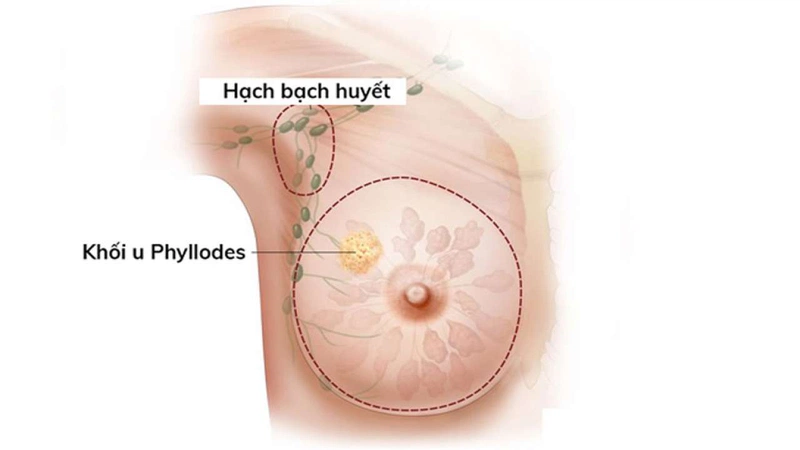 Khối u diệp thể giáp biên và ác tính là gì?1