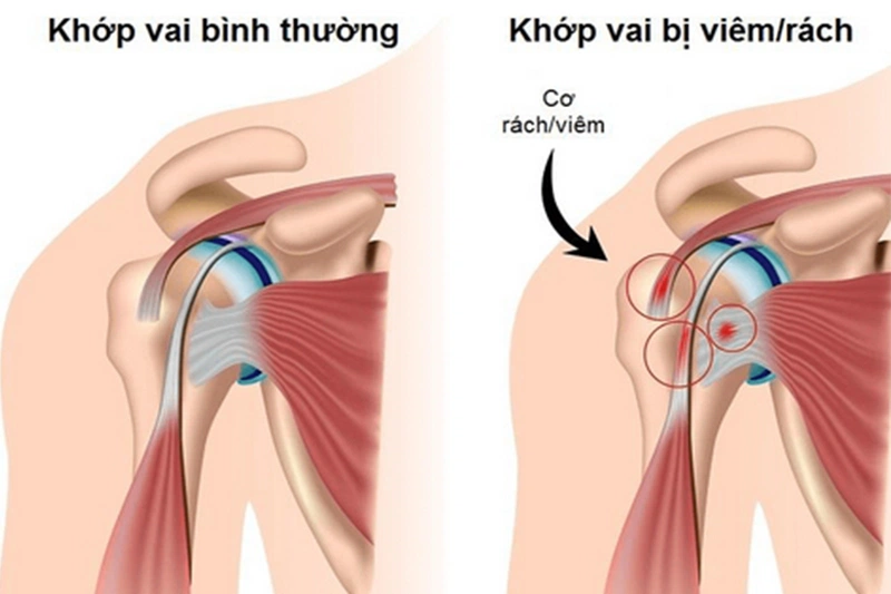 Chấn thương vai khi bơi lội và cách khắc phục hiệu quả 1