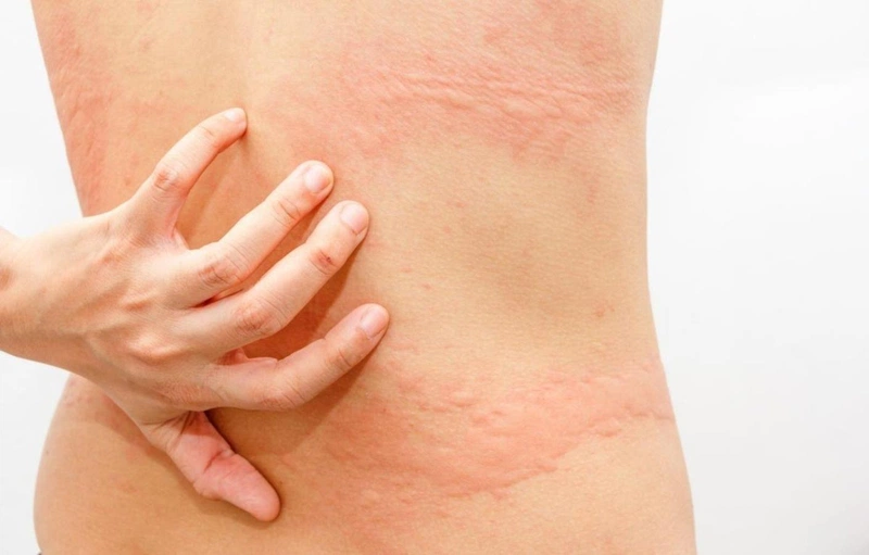 Kỹ năng sơ cứu dị ứng ai cũng nên biết 3