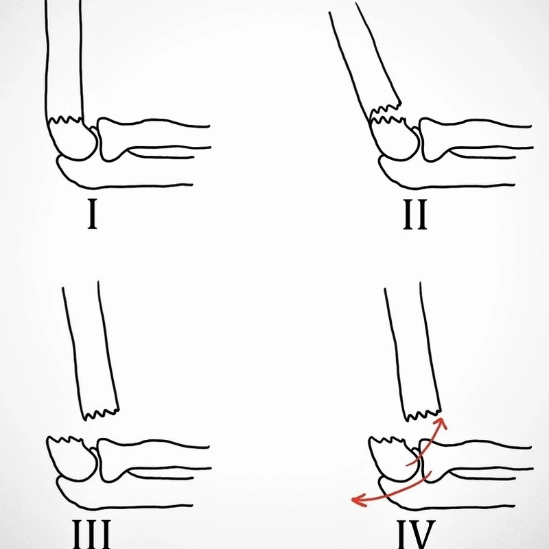 Kỹ thuật nắn trật khớp khuỷu chính xác nhất 3