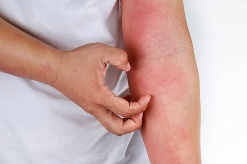 Tại sao cần dùng lá tắm trị mẩn ngứa