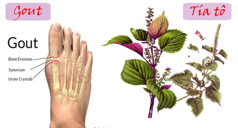 Chữa bệnh gout bằng lá tía tô có được không?