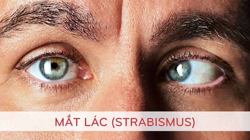 Lác mắt có điều trị được không? 1