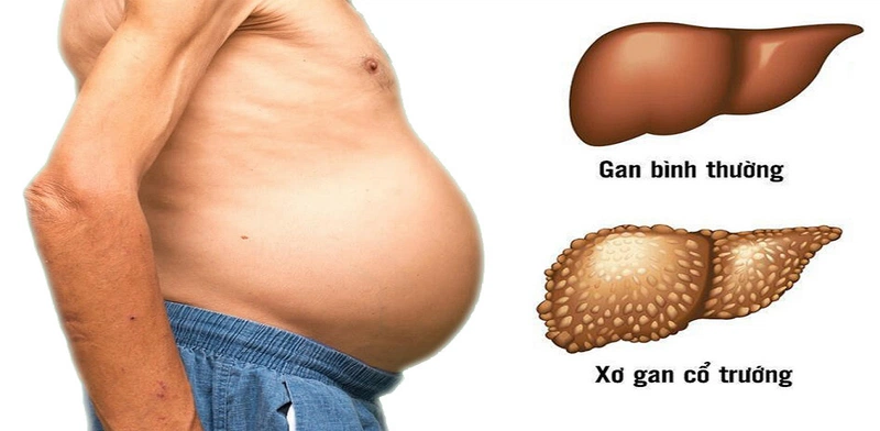 Lách to: Nguyên nhân và cách xử trí 3
