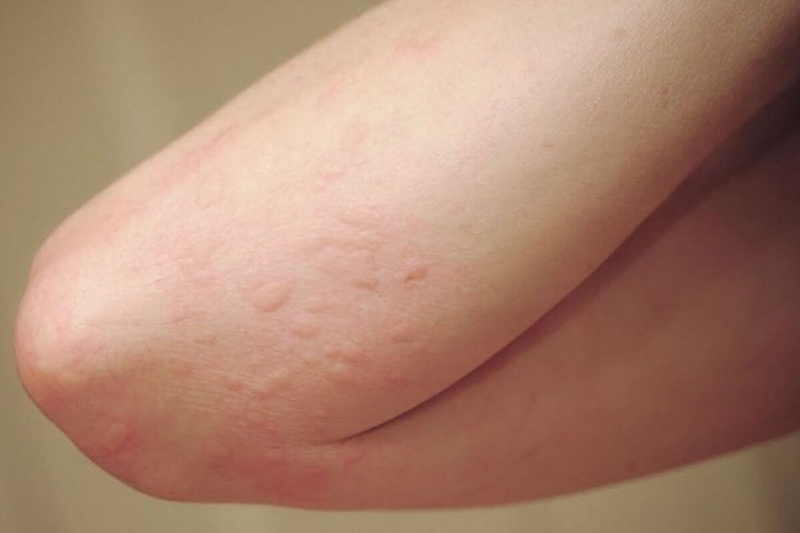 Khả năng giải độc của gan kém đi khiến các độc tố bị tích tụ phát tán qua da gây nên tình trạng mề đay