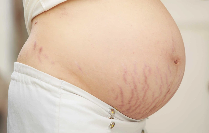 Tình trạng rạn da xuất hiện ở các mẹ bầu mang đa thai, hay thai nhi có trọng lượng lớn