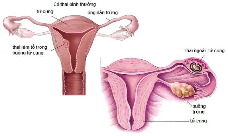 mang thai ngoài tử cung có nguy hiểm không 1