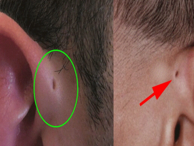 Làm phẫu thuật rò luân nhĩ hết bao nhiêu tiền? 2