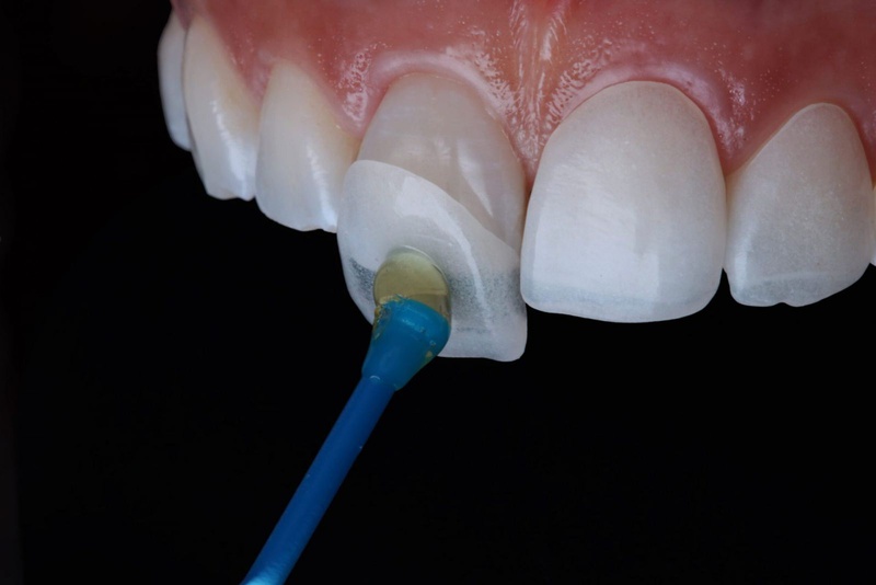 Làm răng sứ bị hở chân răng: Nguyên nhân do đâu và cách khắc phục 1
