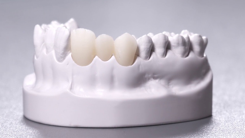 Làm răng sứ bị hở chân răng: Nguyên nhân do đâu và cách khắc phục 2