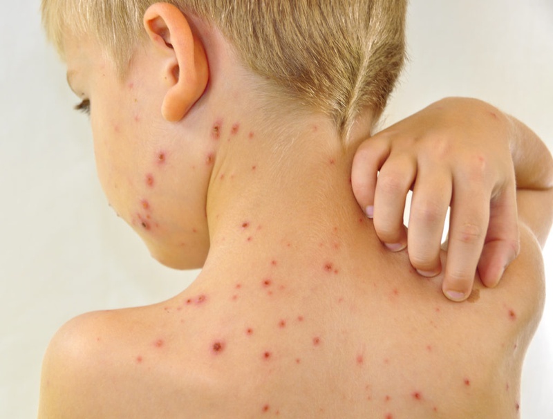Làm sao để hết ngứa khi bị thủy đậu 1
