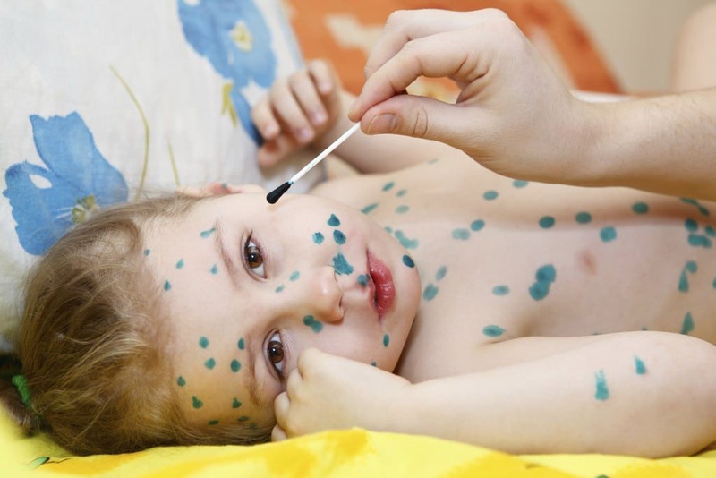 Làm sao để hết ngứa khi bị thủy đậu 3